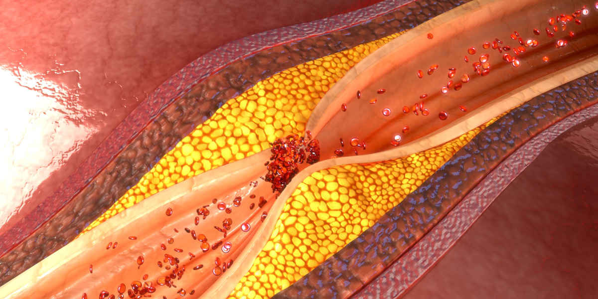 Le cause del colesterolo LDL alto e cibi da evitare